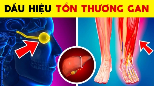 5 dấu hiệu cảnh báo sớm tổn thương gan