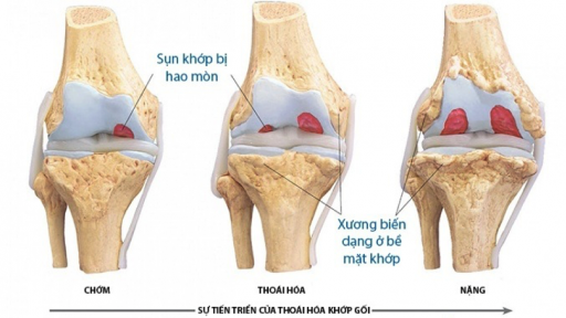 6 yếu tố nguy cơ gây bệnh thoái hóa khớp gối