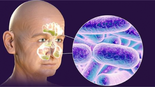 Bộ Y tế khuyến cáo nâng cao phòng, chống bệnh nhiễm khuẩn liên cầu lợn