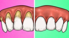 4 dấu hiệu chứng tỏ bạn đang đánh răng quá mạnh