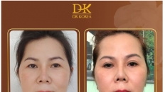 Nâng cung chân mày dấu sẹo tại Dr Korea - Xu hướng Trẻ hóa đôi mắt toàn diện