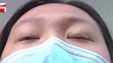 Trung Quốc: Một cô gái phải dán băng dính vào mắt để ngủ sau khi cắt mí mắt
