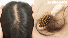 Điều trị rụng tóc không sẹo bằng y học cổ truyền