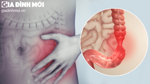 Hội chứng ruột kích thích kiêng gì? 5 thực phẩm cần tránh xa khi bị IBS
