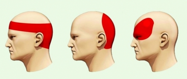   Các loại bệnh đau đầu khác nhau cần có phương pháp điều trị thích hợp - Ảnh: Internet  