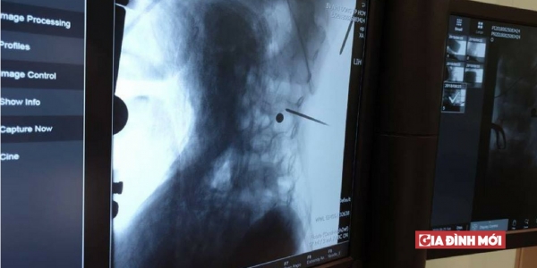 Hình ảnh Xquang cho thấy vị trí viên đạn