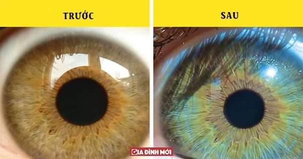 5 điều kỳ lạ có thể làm thay đổi màu mắt của bạn