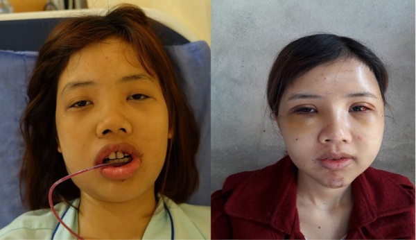 Oanh đã trải qua rất nhiều cuộc phẫu thuật để thay đổi toàn bộ khuôn mặt mình