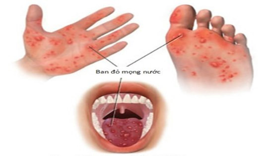   Ban đỏ mọng nước có thể xuất hiện ở bàn tay, bàn chân, miệng... khi bệnh chân tay miệng phát triển - Ảnh minh họa  
