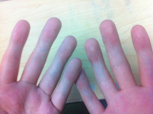 Chứng bệnh lạ khiến bàn tay của tôi biến dạng và dường như không có nếp nhăn