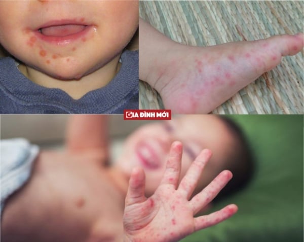   Bệnh chân tay miệng ở trẻ nhỏ chưa có thuốc điều trị đặc hiệu, chưa có vắc-xin phòng ngừa - Ảnh minh họa  