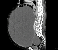   Hình ảnh chụp khối u buồng trứng khổng lồ của bệnh nhân  
