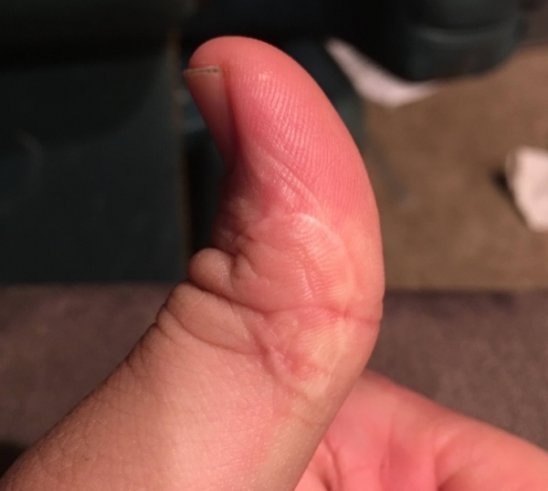 Vết sẹo trên ngón tay tôi nhìn giống một cái đầu lâu