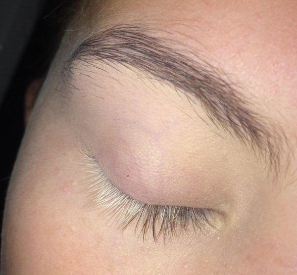 Một nửa lông mi trên mắt phải của tôi là màu trắng vì bệnh bạch biến