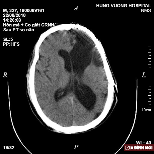   Hình ảnh não bị tổn thương của bệnh nhân  
