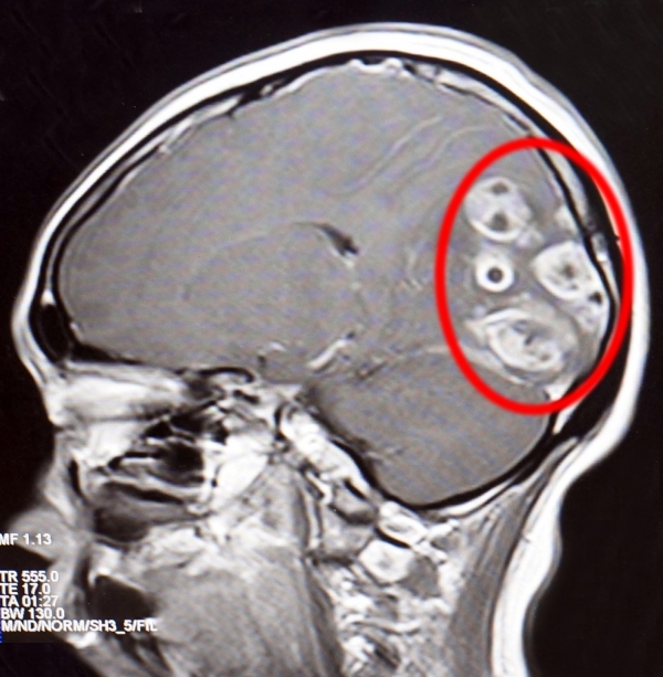 Một trong những kết quả Xquang chỉ rõ có khối u trong não