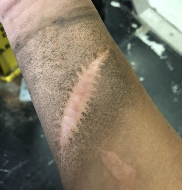 Vết sẹo này không bám bẩn khi tôi làm việc