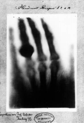 Bức ảnh chụp X-quang đầu tiên thế giới bởi Wilhelm Röntgen vào ngày 22/12/1895