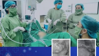 Bóc tách thành công khối u xơ tử cung 'đi lạc' hiếm gặp tại thành bụng