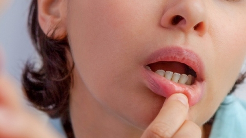 Vết loét trong miệng có thể là dấu hiệu của ung thư