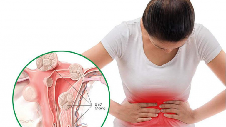 Giải pháp giúp kiểm soát u xơ tử cung an toàn, hạn chế tái phát 