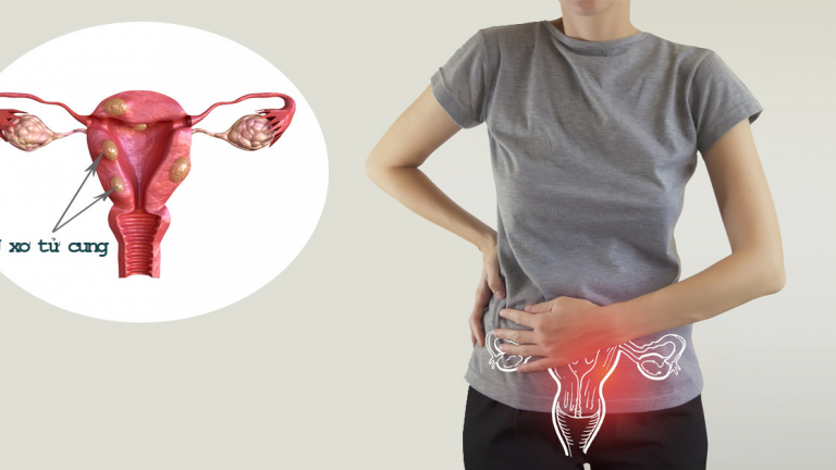 Vì sao u xơ tử cung dưới 50mm được xem là “giai đoạn vàng” để kiểm soát? 