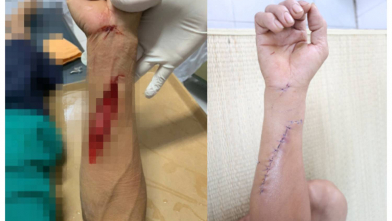 Bị kính vỡ cắt phải, người đàn ông suýt mất chức năng bàn tay do đứt gân, tổn thương nặng