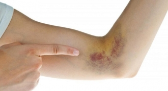 Vết bầm tím đột nhiên xuất hiện trên da: Dấu hiệu cảnh báo nhiều bệnh nguy hiểm