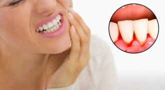 Chảy máu chân răng: Nguy cơ tiềm ẩn nhiều bệnh lý nguy hiểm chớ nên xem nhẹ