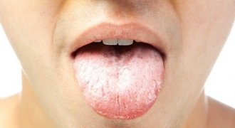 Dấu hiệu lạ ở lưỡi “tố cáo” sức khỏe bạn đang gặp vấn đề nghiêm trọng