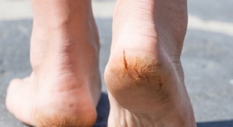 Những dấu hiệu ở bàn chân dễ cảnh báo cơ thể mang “trọng bệnh”