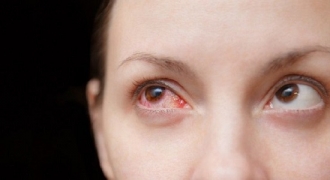 Bác sĩ cảnh báo đau mắt đỏ có thể là triệu chứng của COVID-19