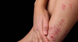 Các dạng viêm nhiễm da chân trong mùa mưa và cách phòng tránh