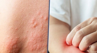 Bệnh ngoài da tăng mạnh do nồm ẩm: Bác sĩ chỉ lý do nhiều người mắc phải