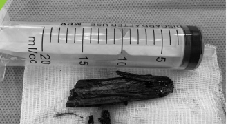 Dị vật dài 6cm mắc kẹt trong mông bé trai