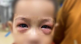 Gần 50 trẻ nhập viện viêm kết mạc cấp, cảnh báo dịch đau mắt đỏ lây lan nhanh