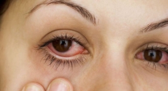 Xử lý nghiêm việc lợi dụng dịch đau mắt đỏ để tăng giá thuốc điều trị