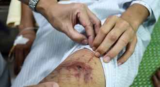 Thêm một bệnh nhân tử vong do sốt xuất huyết ở Hà Nội