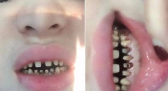 Hàm răng của cô gái trẻ tại Hà Nội bị hư hỏng nặng sau 2 năm bọc sứ