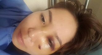 Vợ khẩn cứu công an vì bị chồng đánh vỡ xương xoang mũi, nguy cơ bị hỏng mắt