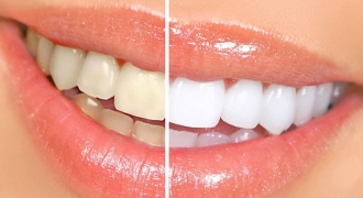 Nụ cười tỏa sáng chỉ nhờ 5 cách làm trắng răng đơn giản tại nhà