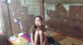 Hà Tĩnh: Hoàn cảnh thương tâm của người phụ nữ bị bệnh lạ đục khoét mặt