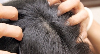 Hết ngứa da đầu, sạch gầu mùa hanh khô nhờ cách làm đơn giản này