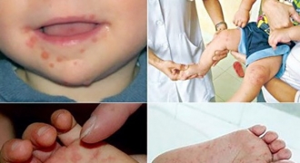 Bộ Y tế khuyến cáo cách phòng chống bệnh tay chân miệng và bệnh sởi
