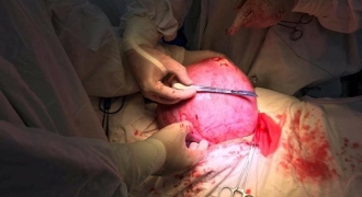 Phẫu thuật khối u xơ tử cung to bằng thai 9 tháng
