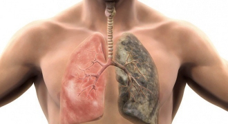 Những triệu chứng cảnh báo bệnh nghiêm trọng về phổi