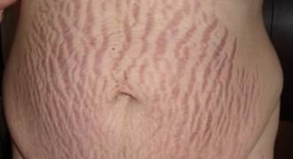 Cách trị rạn da sau sinh hiệu quả chỉ sau 3 tháng