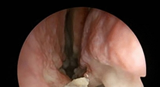 Tưởng khối u… tá hỏa phát hiện răng mọc trong lỗ mũi