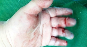 Cho tay vào máy xay thịt, bé trai 16 tháng tuổi bị dập nát 3 ngón tay