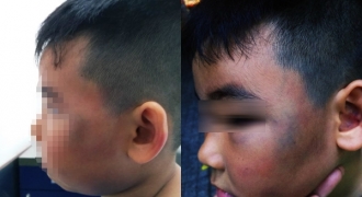 Bé trai 8 tuổi bị đánh bầm dập vì nghi ăn trộm gà: Công an vào cuộc